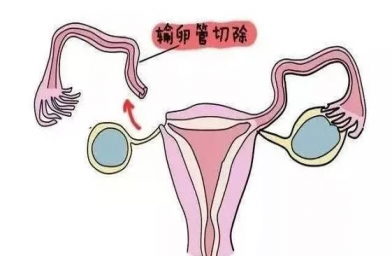 贵州慈铭博鳌国际医院三代试管婴儿，切除双侧输卵管还能做试管婴儿吗？